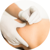 Service - Dry Needling Service - Dry Needling
